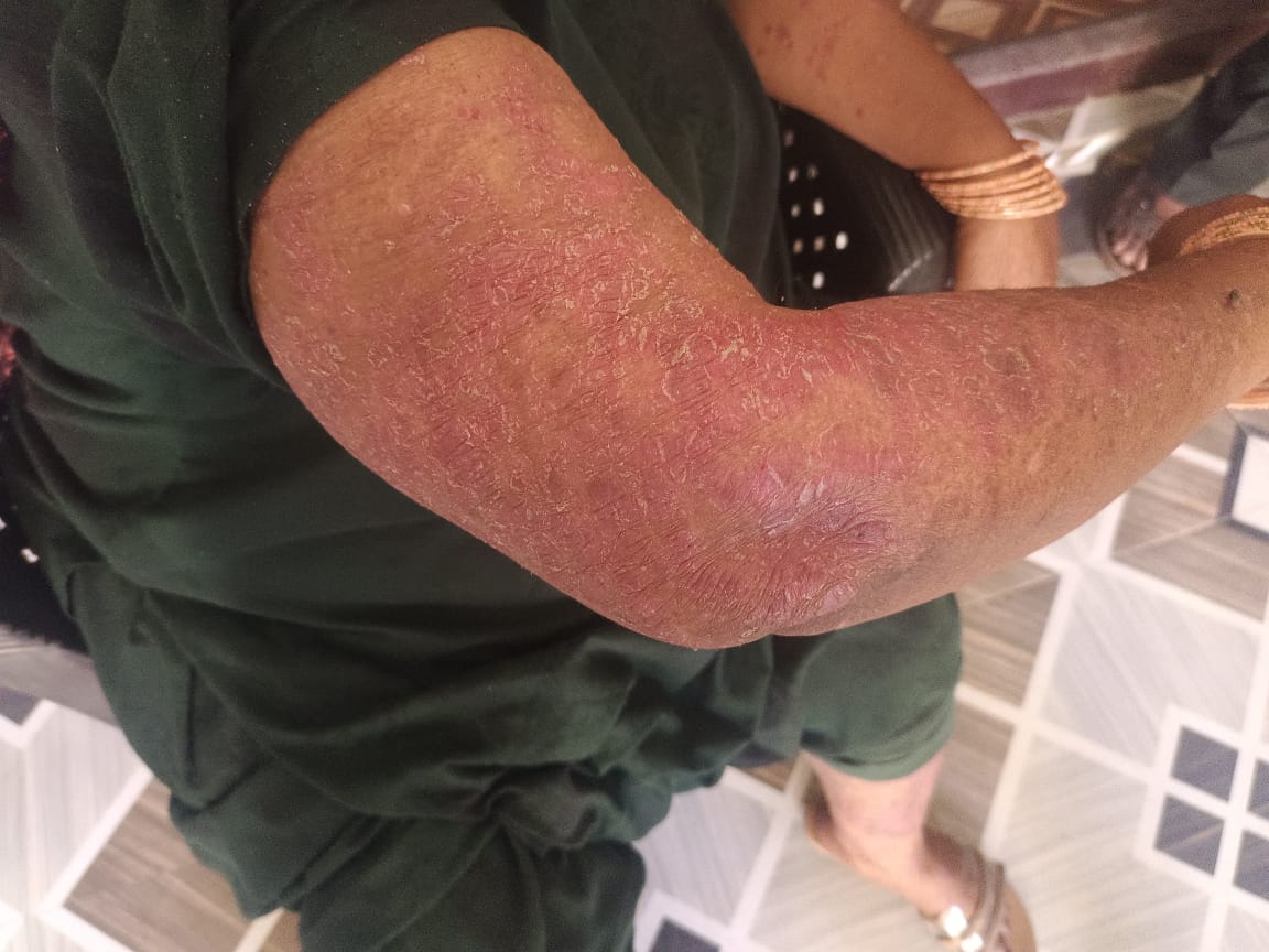 Before Skin Problem